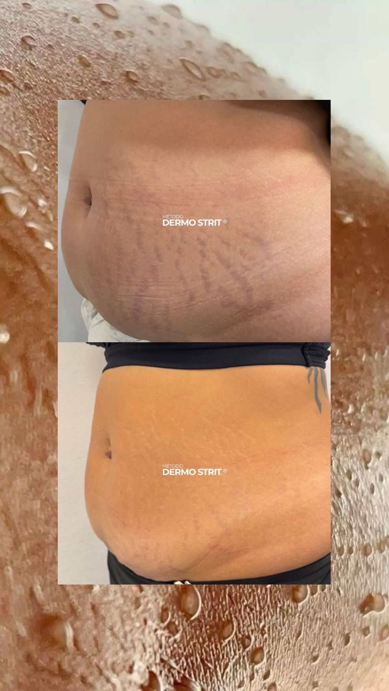 Antes e depois — Método Dermo Strit