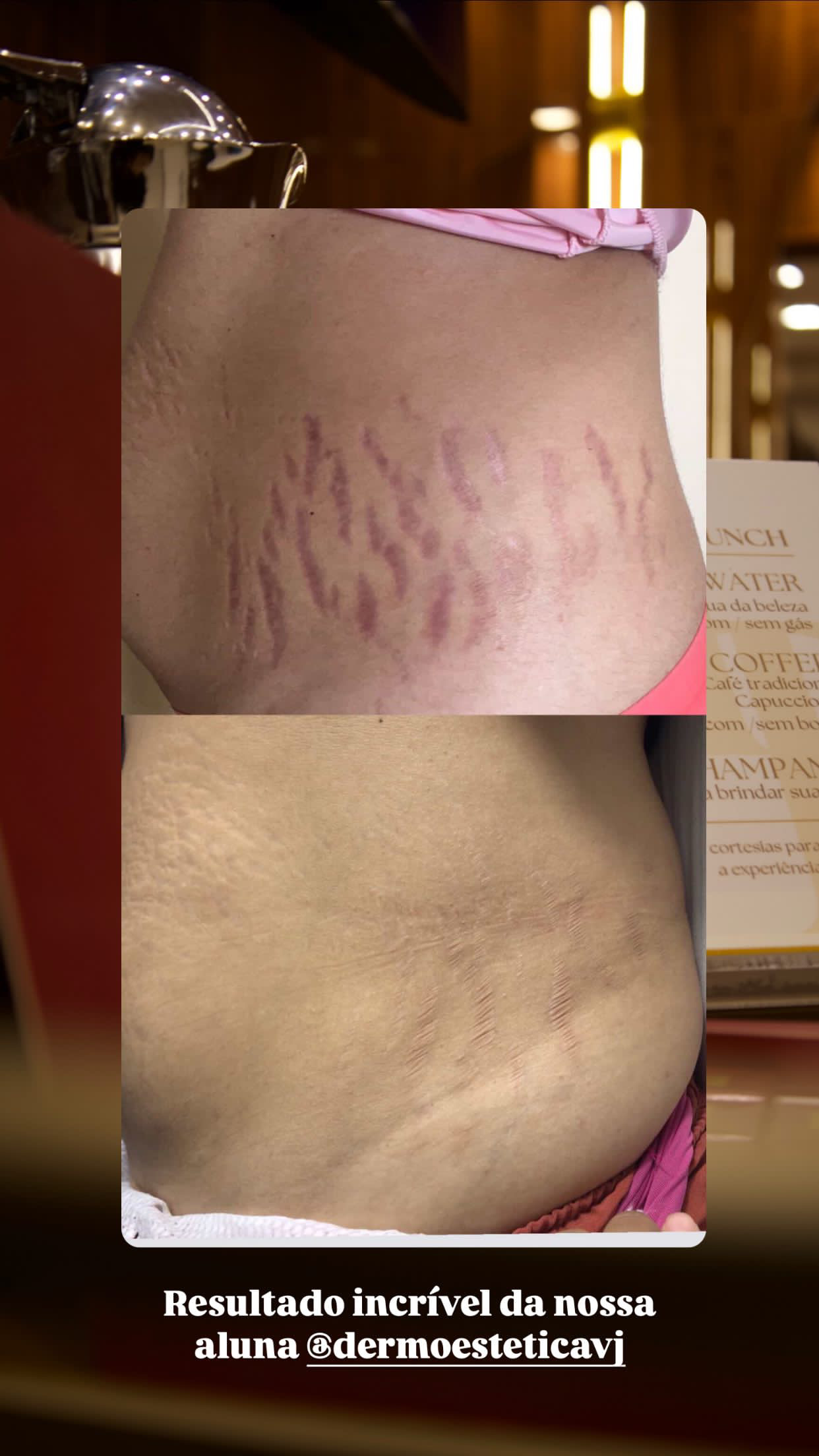 Antes e depois — Método Dermo Strit