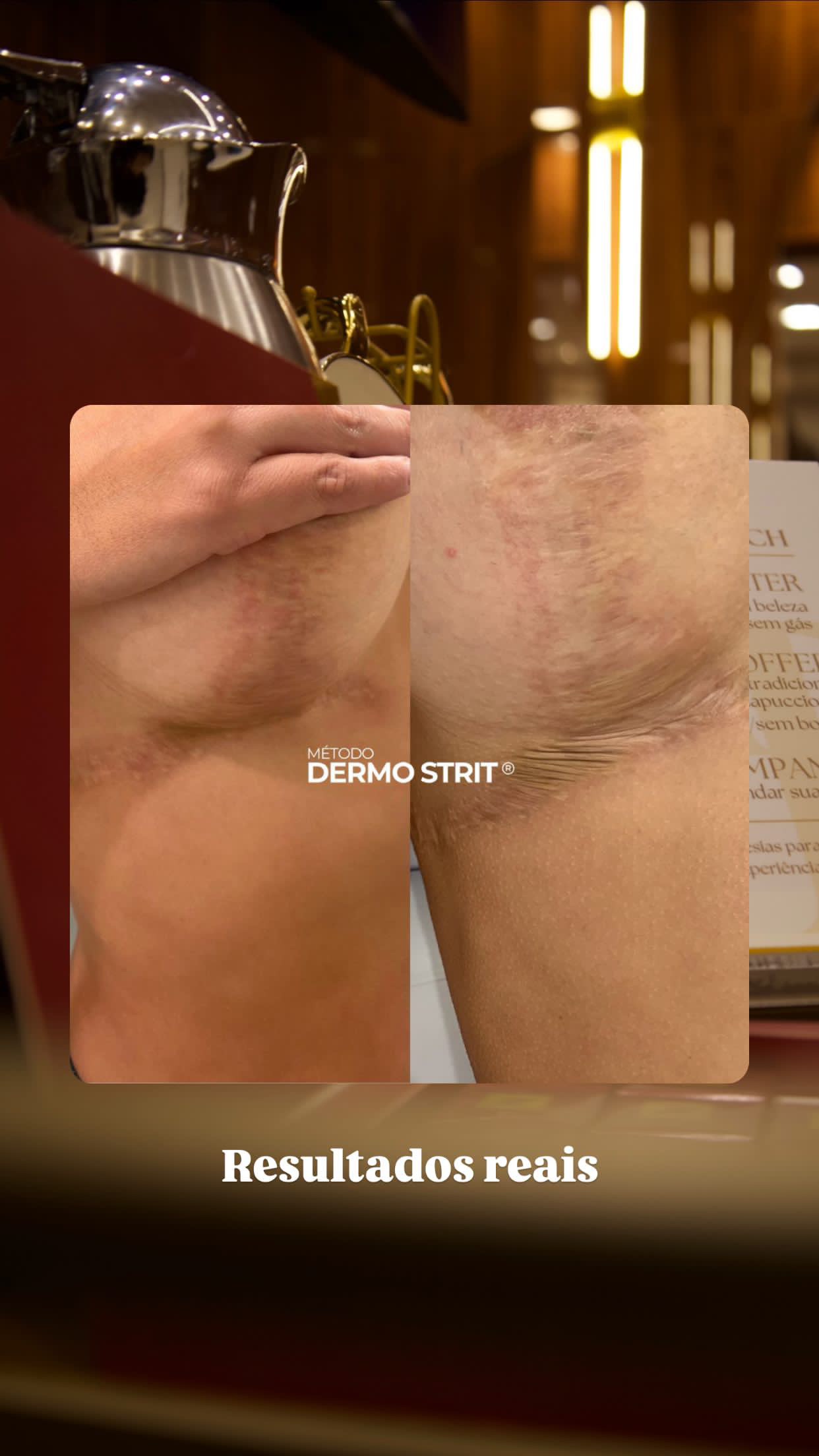 Resultado — Método Dermo Strit