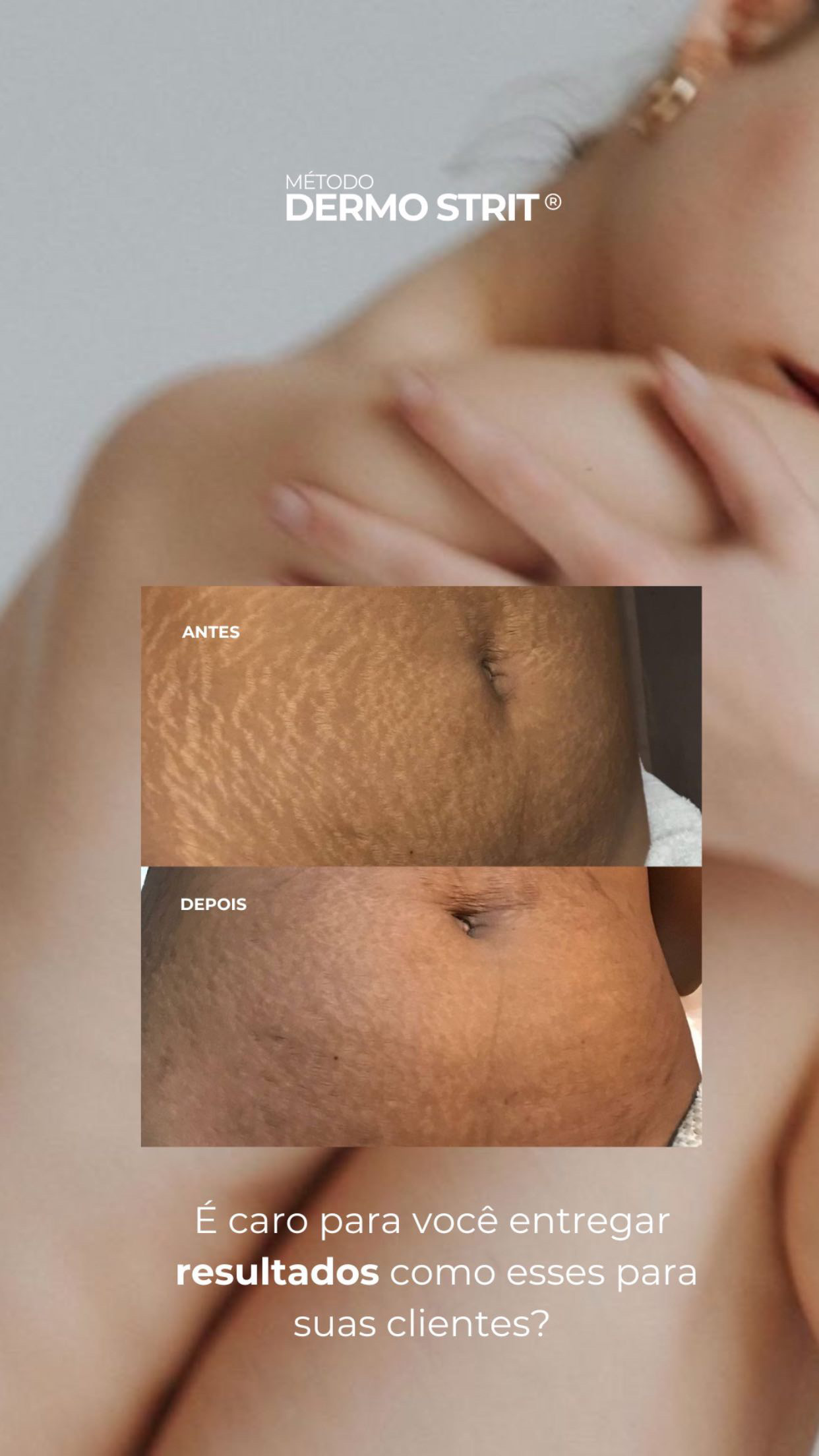 Resultado — Método Dermo Strit