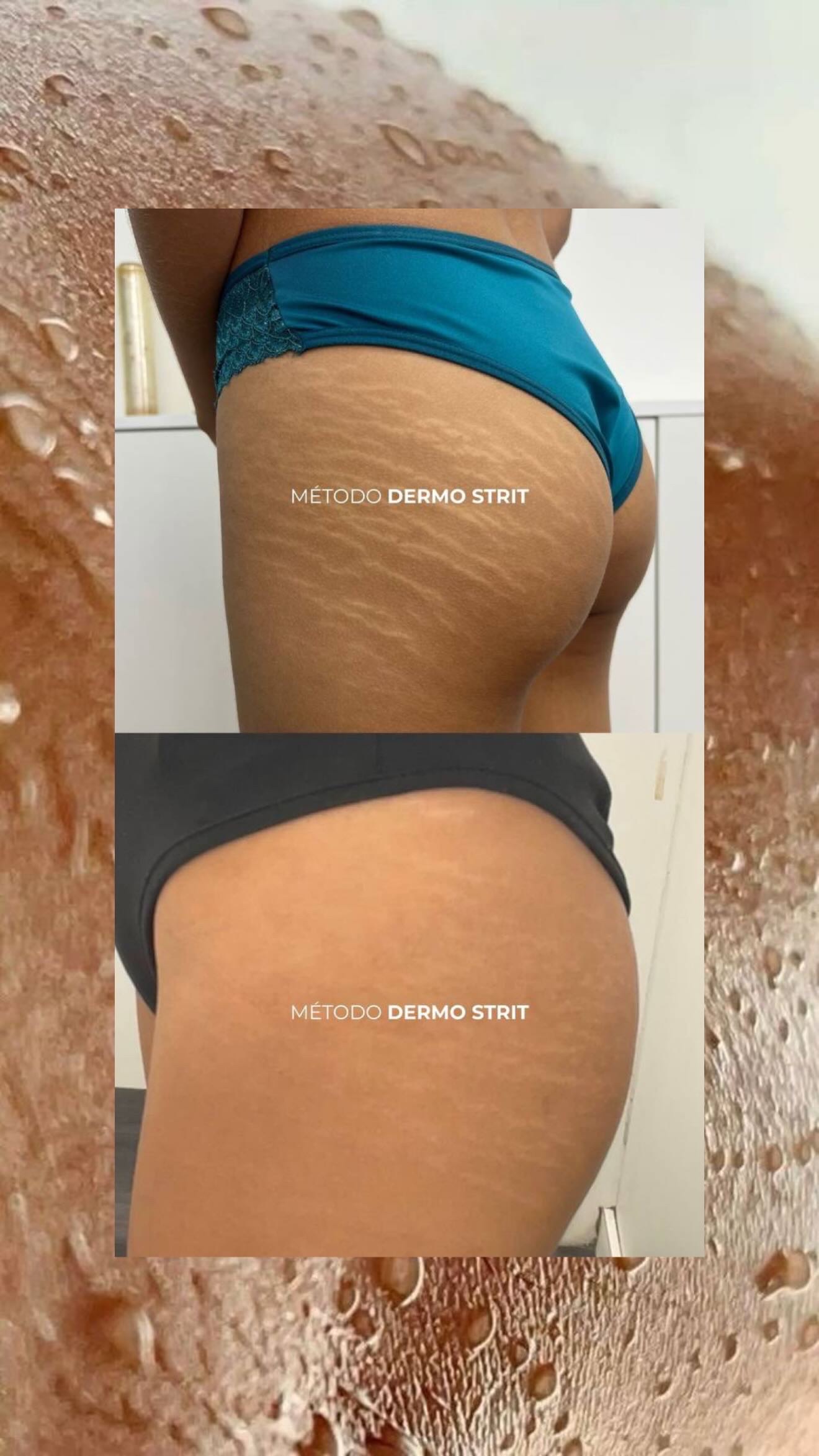 Antes e depois — Método Dermo Strit